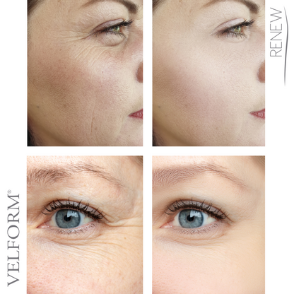 Parches Faciales Antiaging con Colágeno y Ácido Hialurónico | Tratamiento Lifting con Bruma Booster